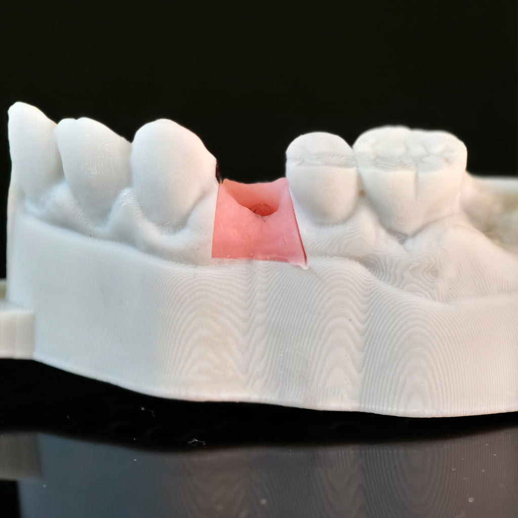 Zirconia Crowns With Screw Retained