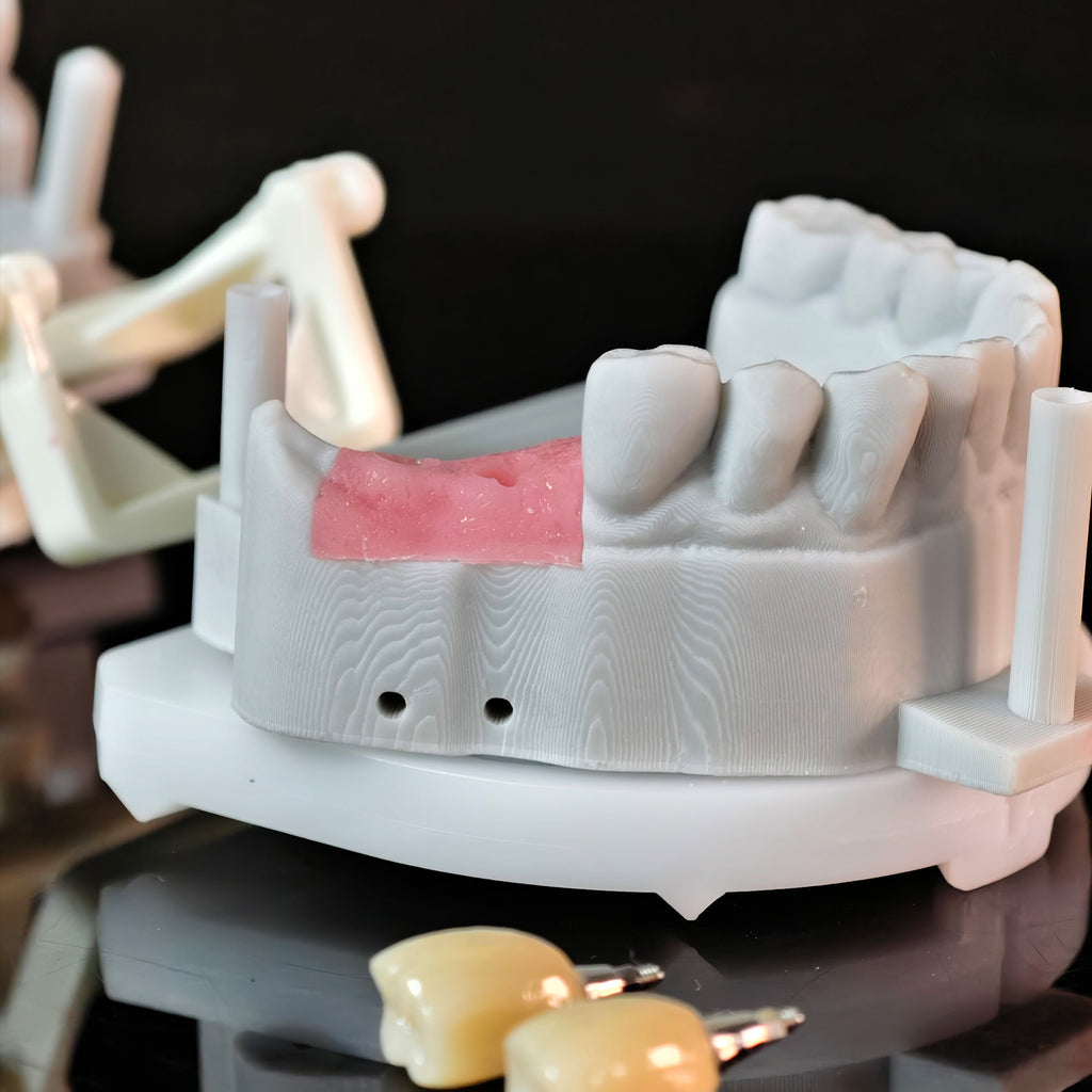 Zirconia Crowns With Screw Retained