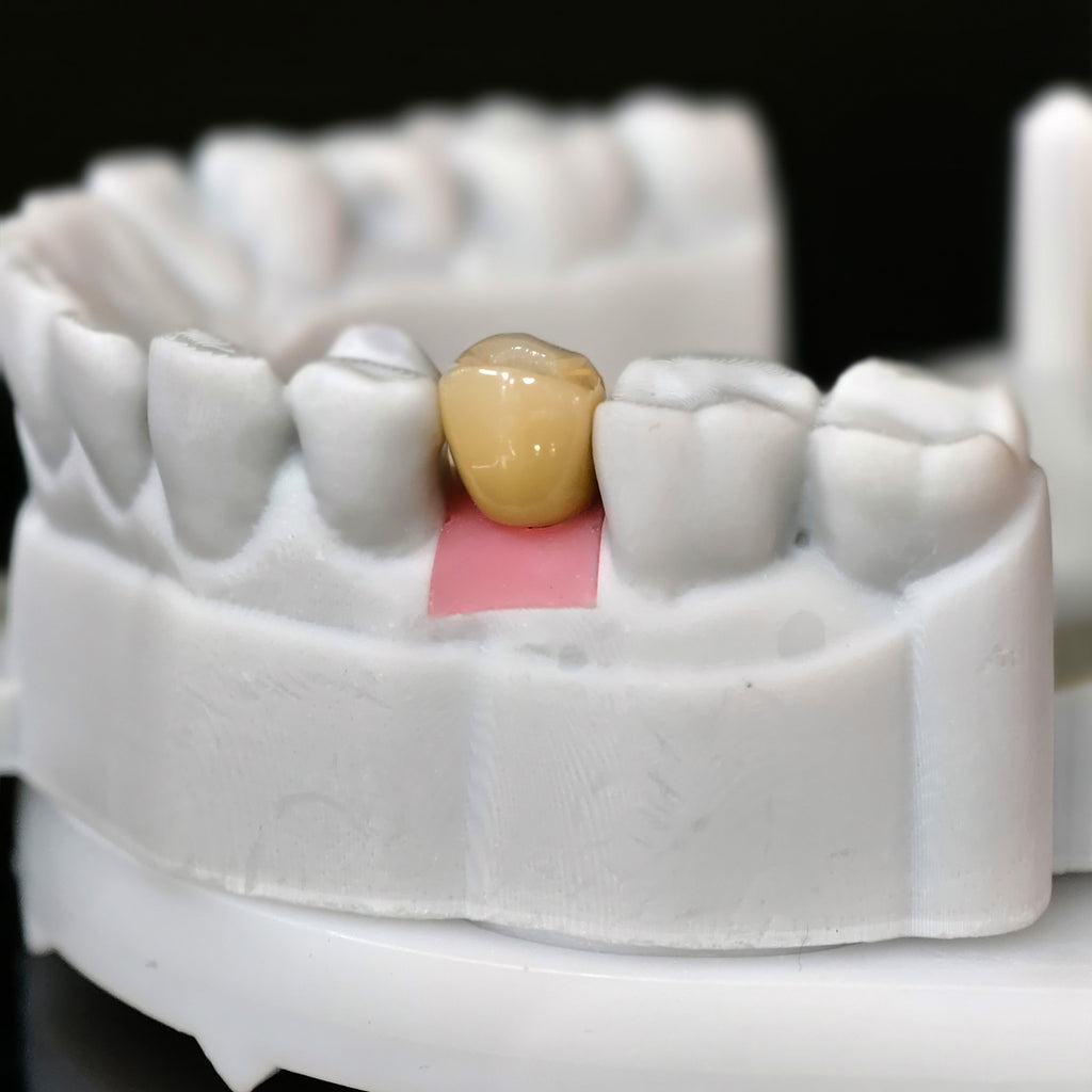 Zirconia Crowns With Screw Retained