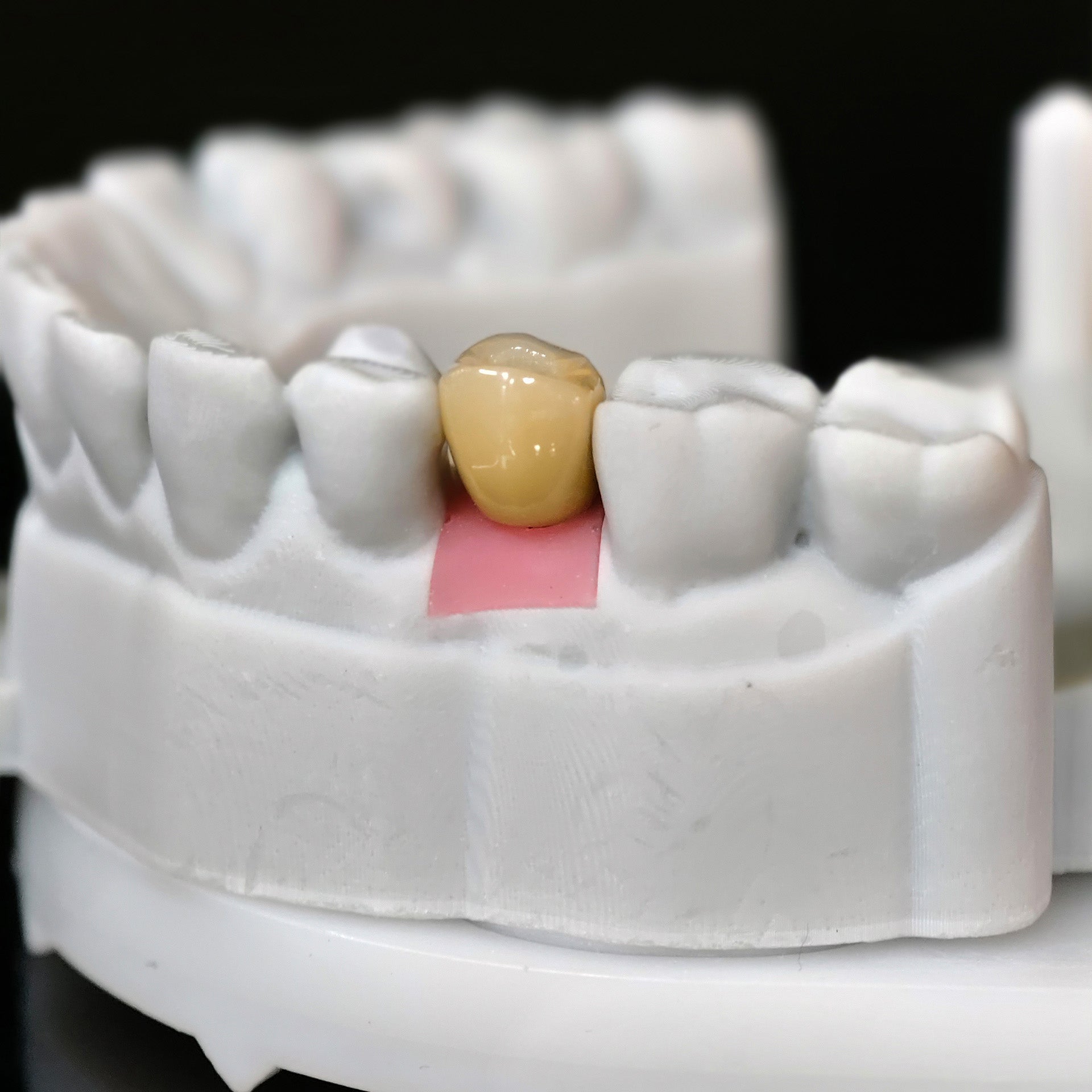 Zirconia Crowns With Screw Retained
