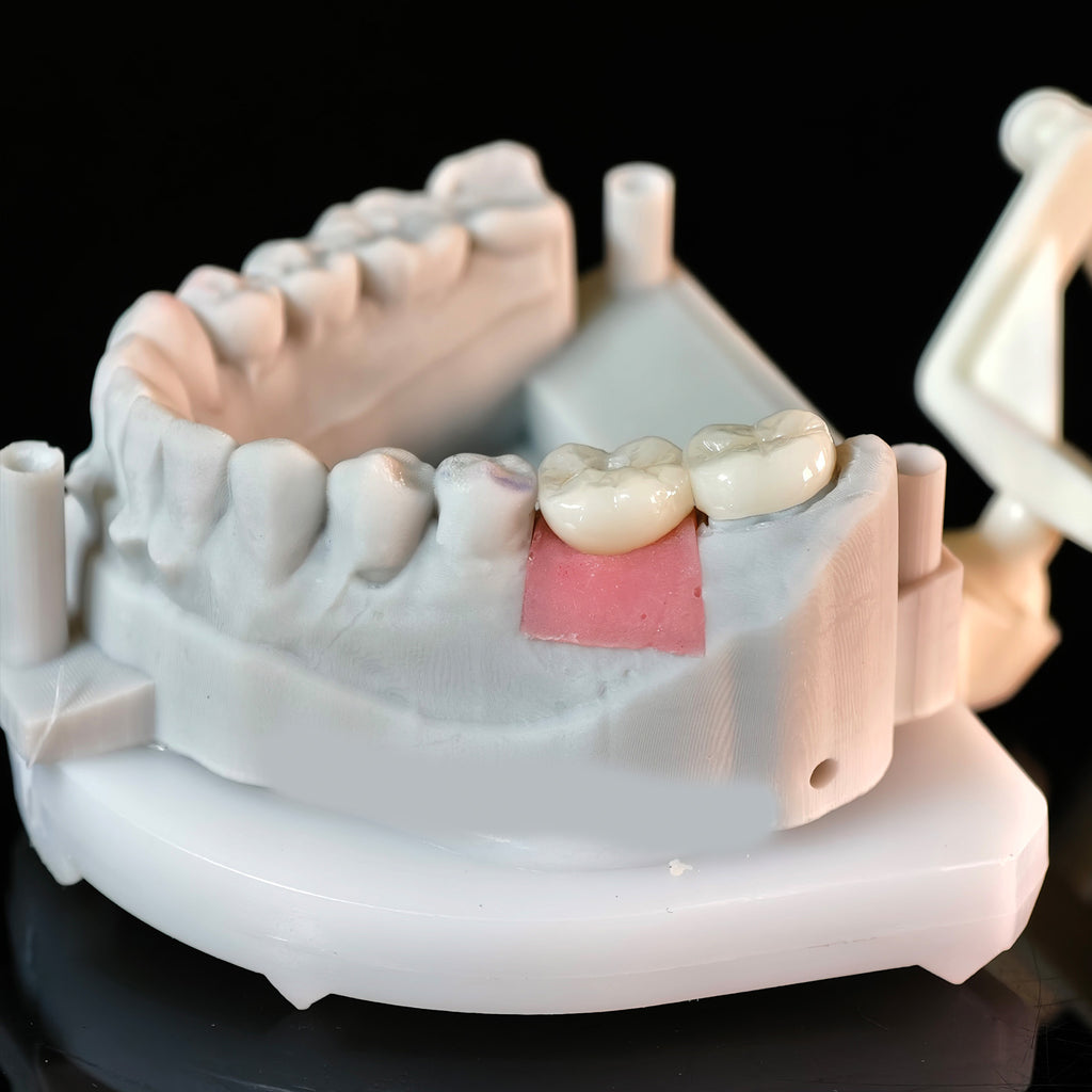 Zirconia Crowns With Screw Retained And Cement Retained