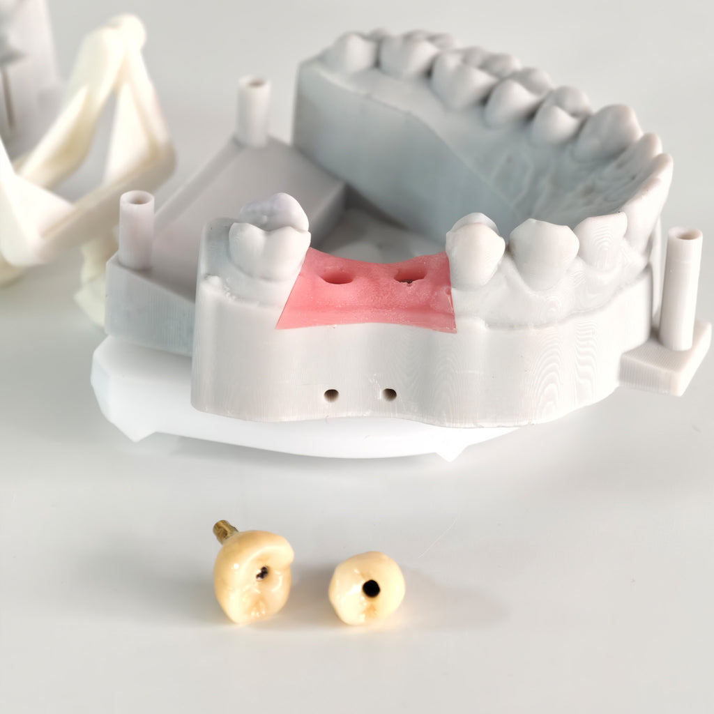 Zirconia Crowns With Screw Retained And Gold-Plated Custom Abutment