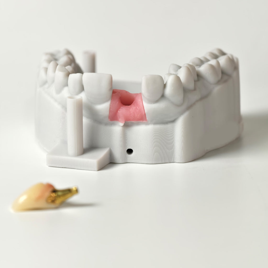 Zirconia Crown With Gold-Plated Abutment