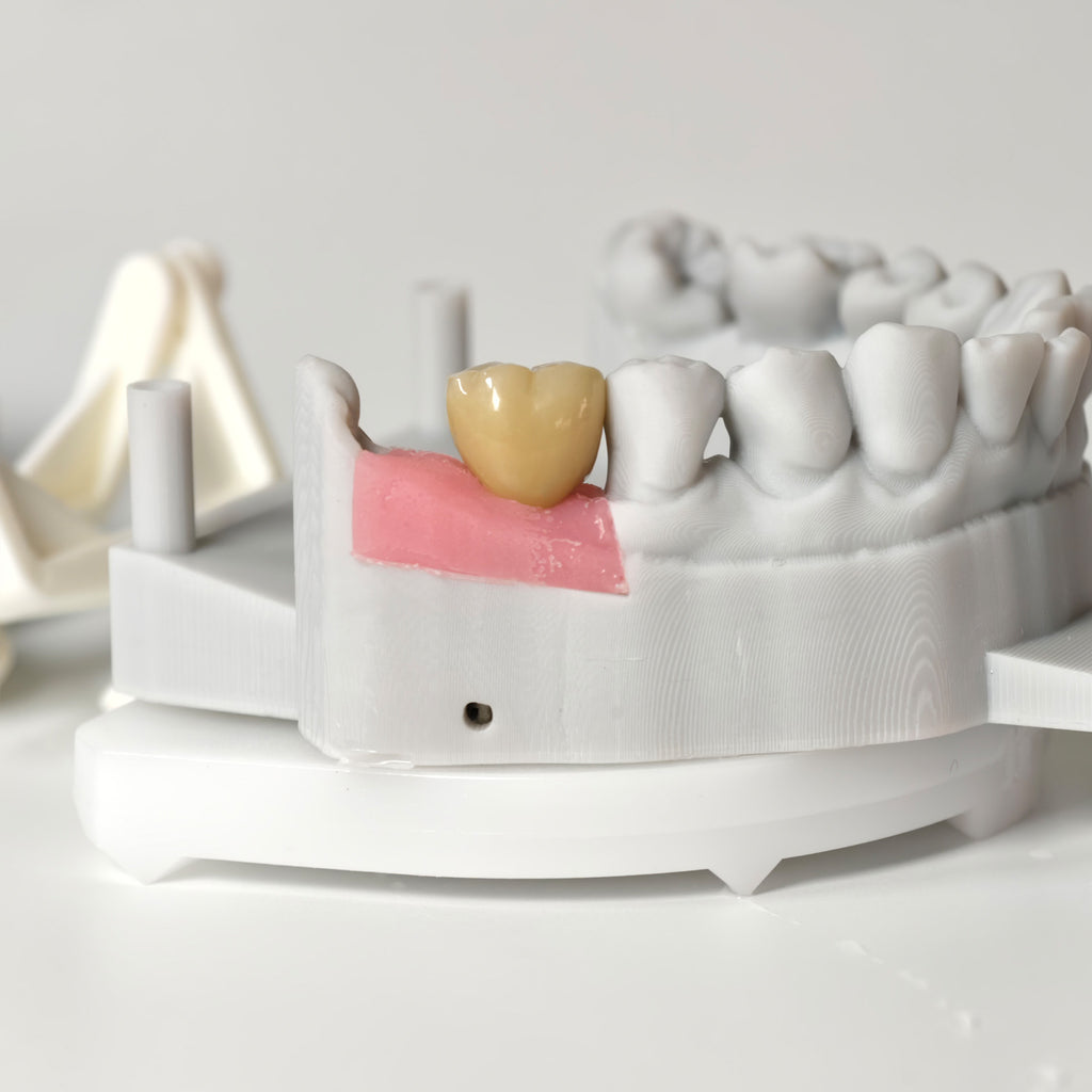 Zirconia Crown With Gold-Plated Abutment