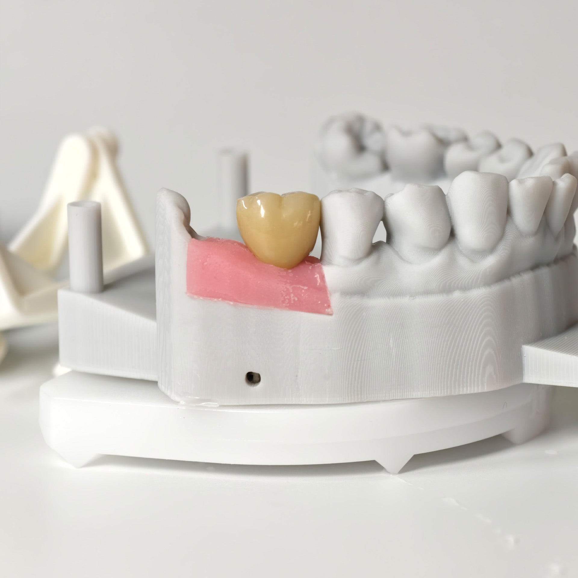 Zirconia Crown With Gold-Plated Abutment