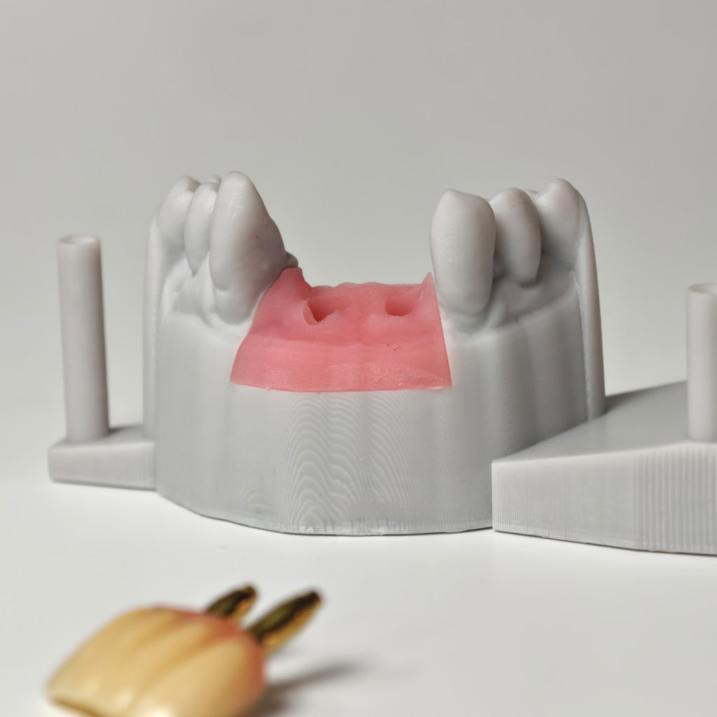 Zirconia Crown With Gold-Plated Abutment