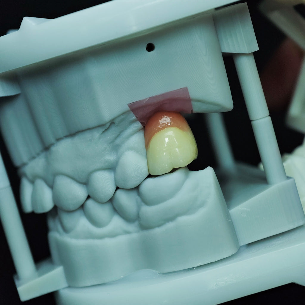 Zirconia Crown With Screw Retained