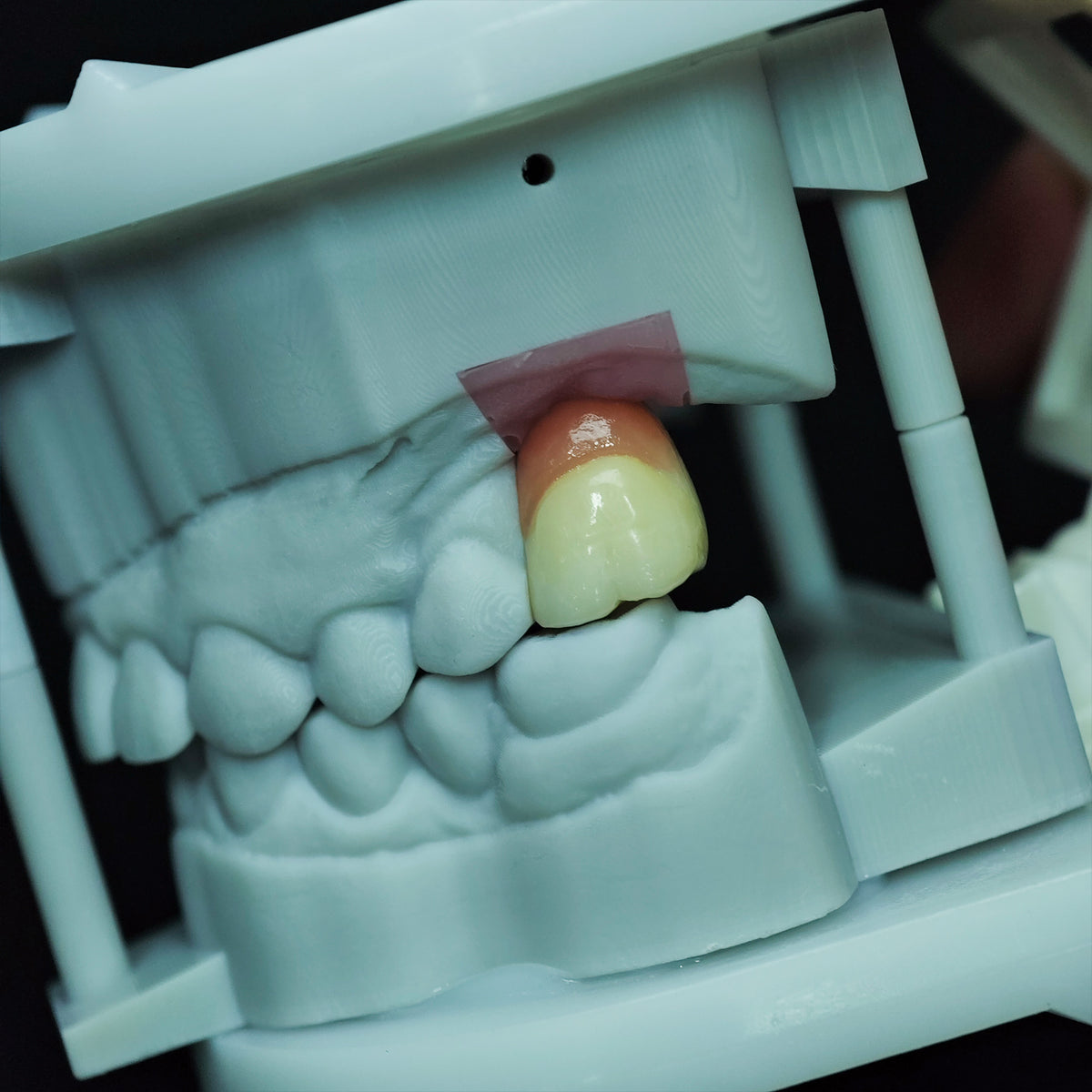 Zirconia Crown With Screw Retained