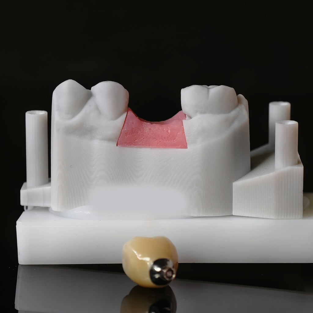 Zirconia Crown With Screw Retained