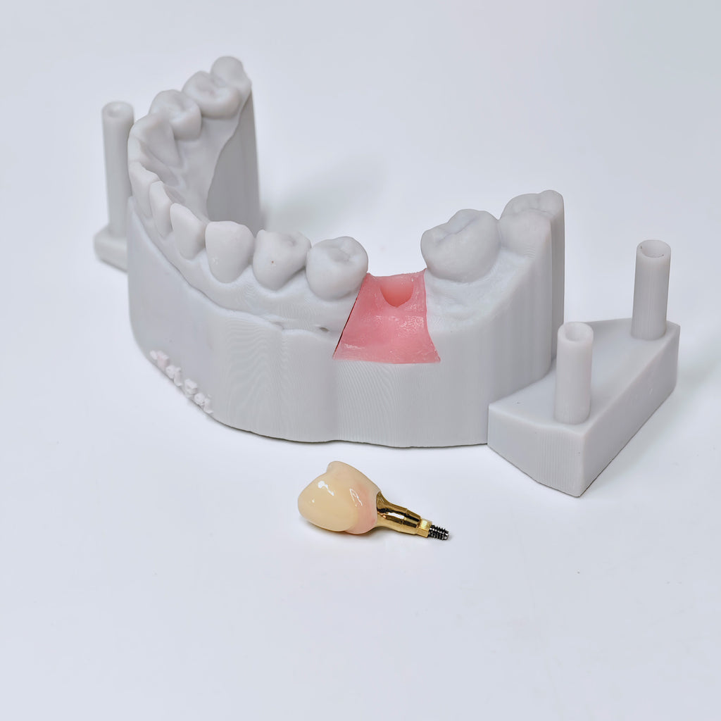 Zirconia Crown With Screw Retained