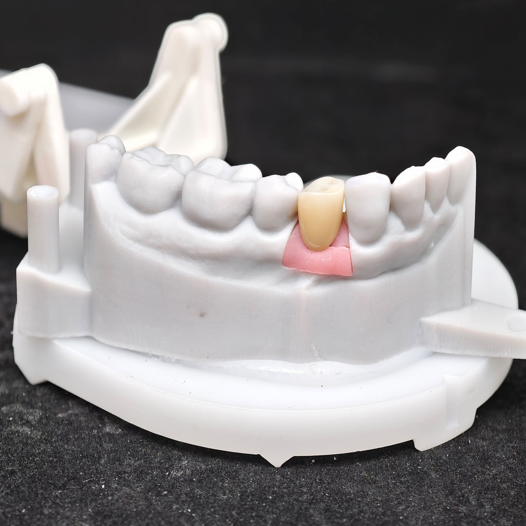 Zirconia Crown With Screw Retained