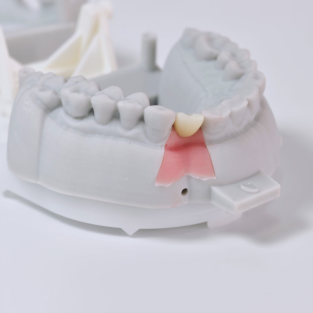 Zirconia Crown With Screw Retained