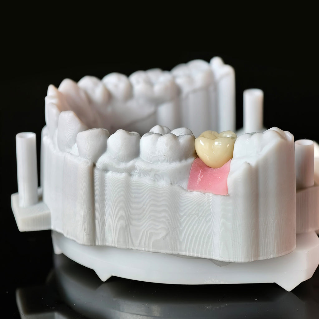 Zirconia Crown With Screw Retained