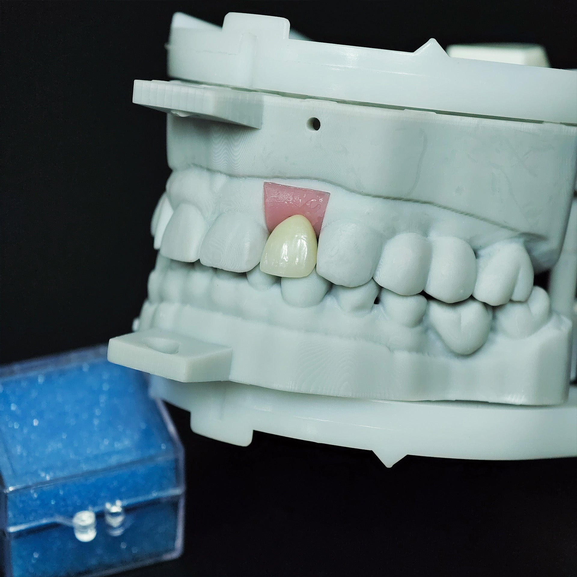 Zirconia Crown With Screw Retained