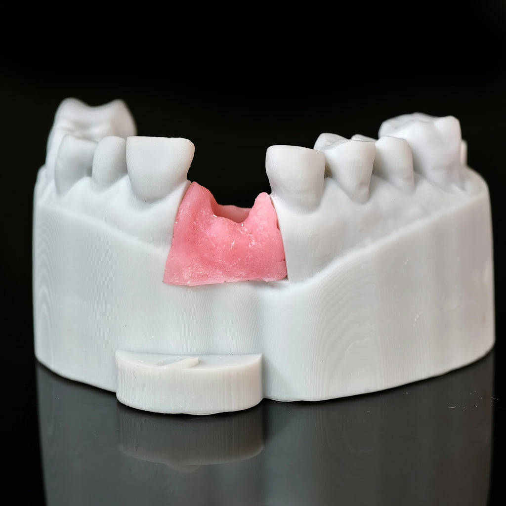Zirconia Crown With Screw Retained
