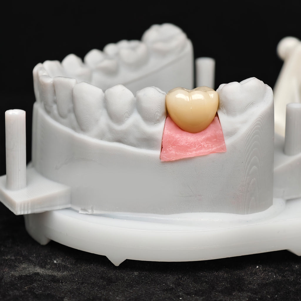 Zirconia Crown With Screw Retained