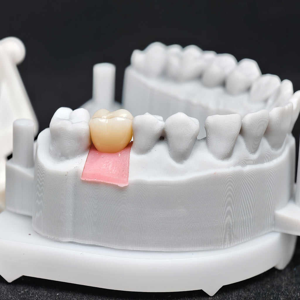 Zirconia Crown With Screw Retained