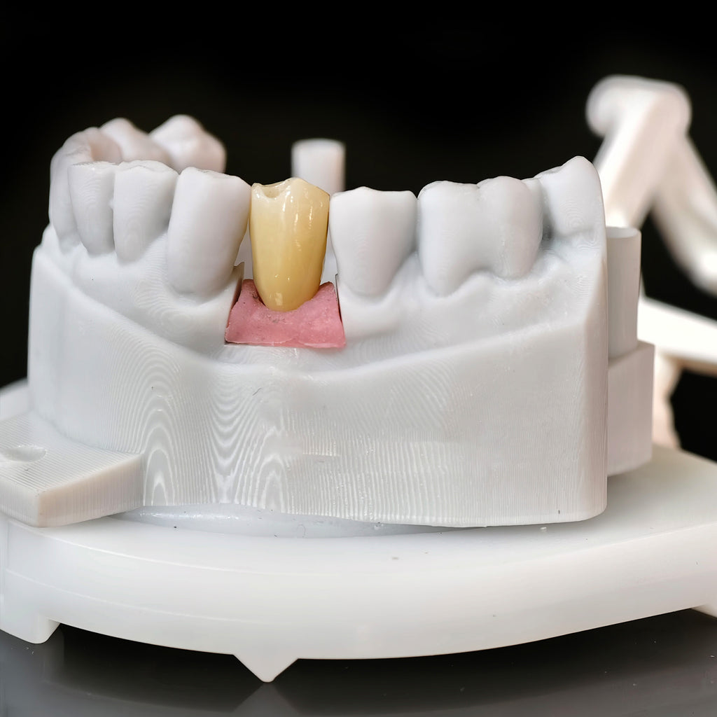 Zirconia Crown With Screw Retained