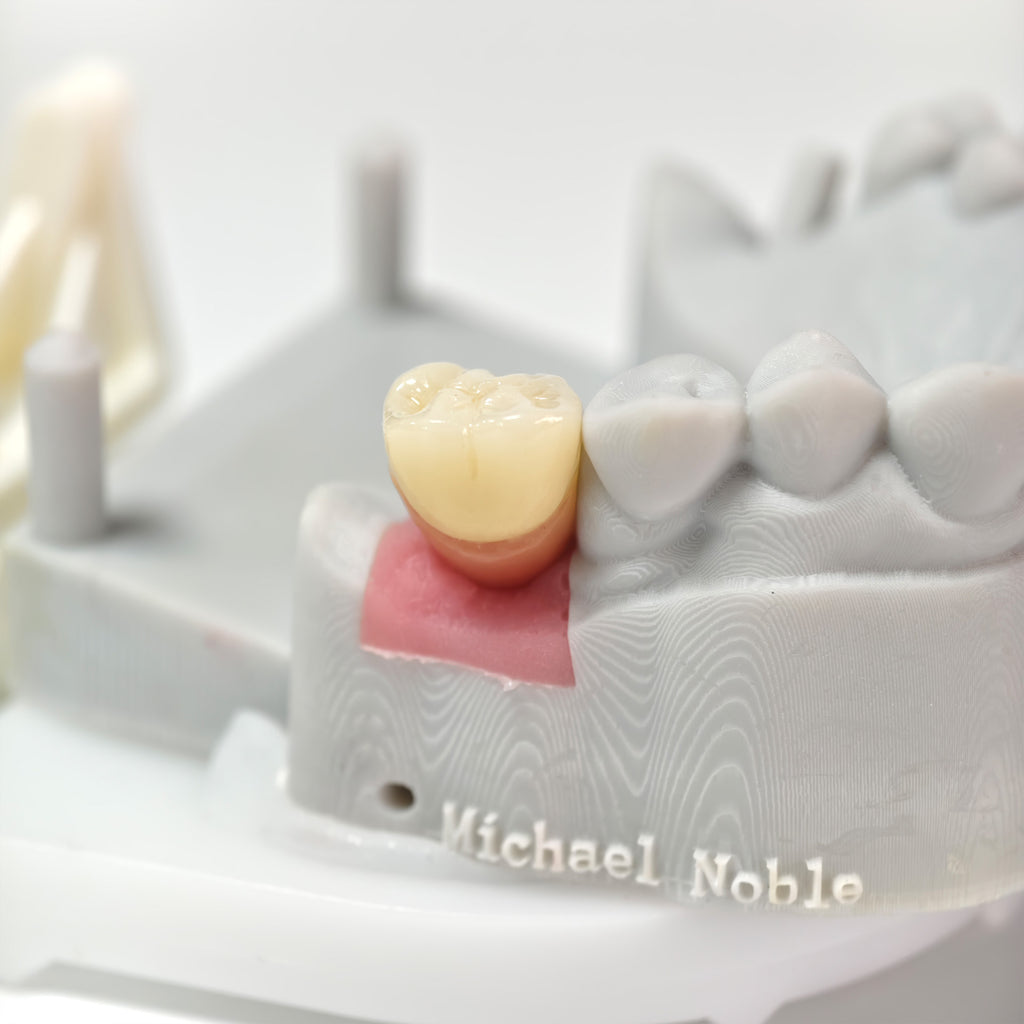 Zirconia Crown With Screw Retained
