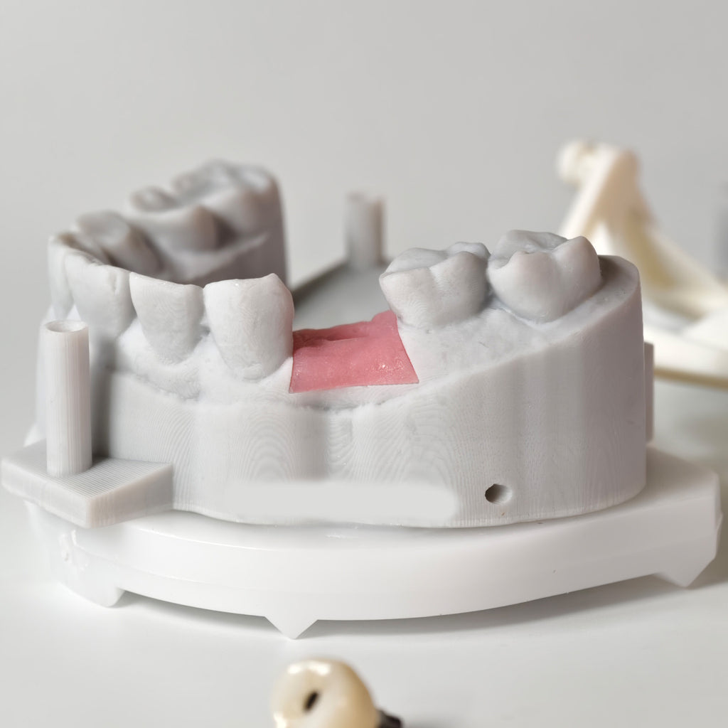 Zirconia Crown With Screw Retained