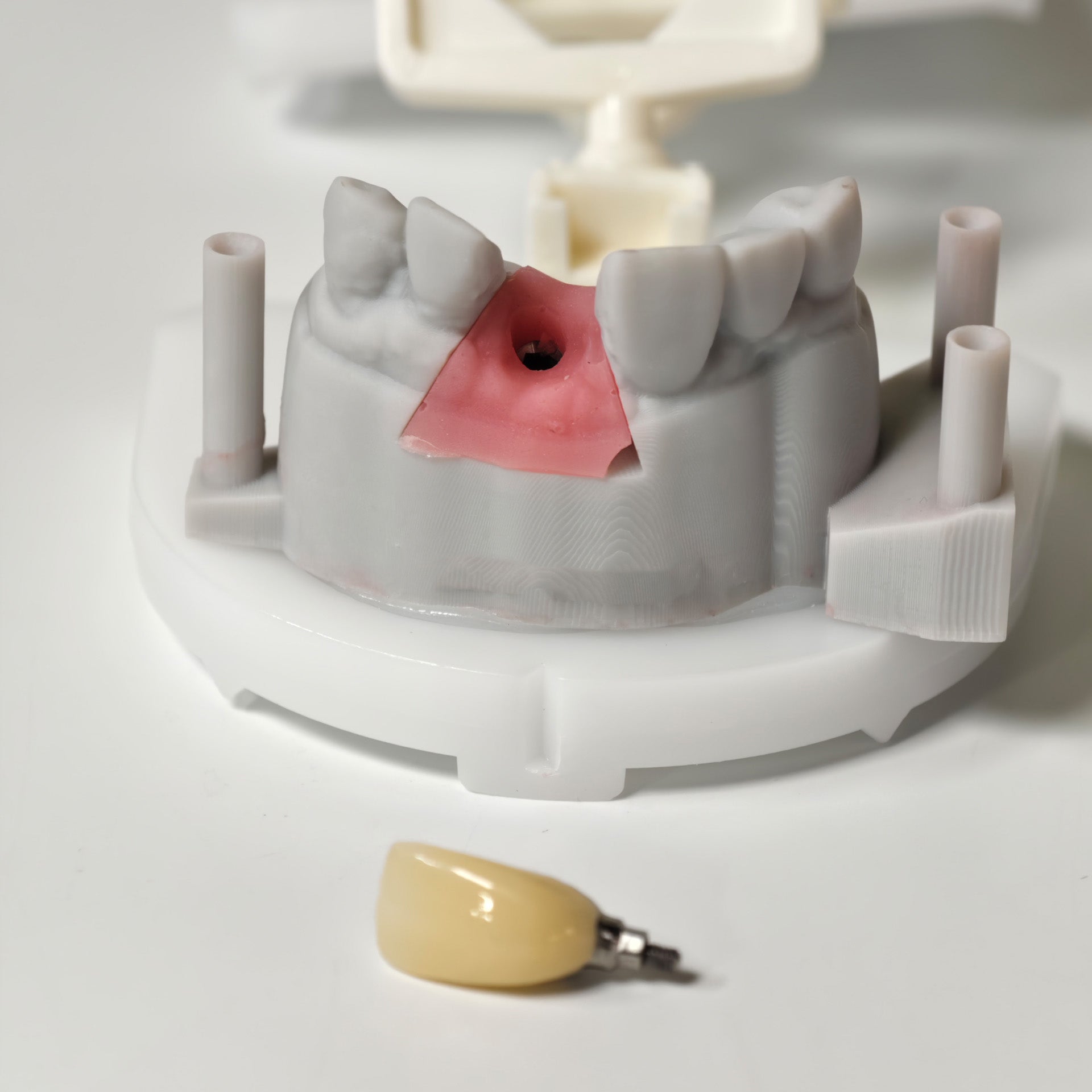 Zirconia Crown With Screw Retained