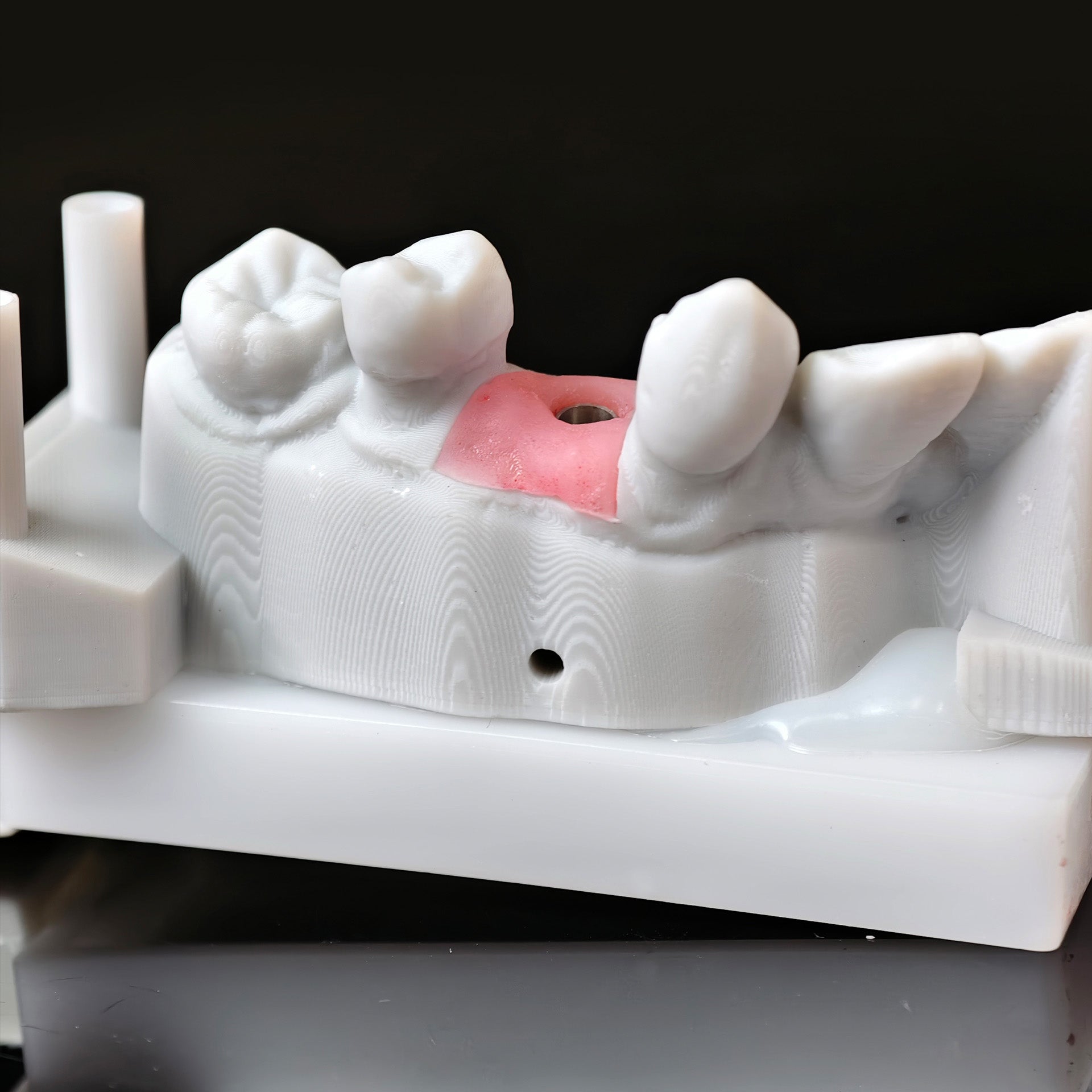 Zirconia Crown With Screw Retained