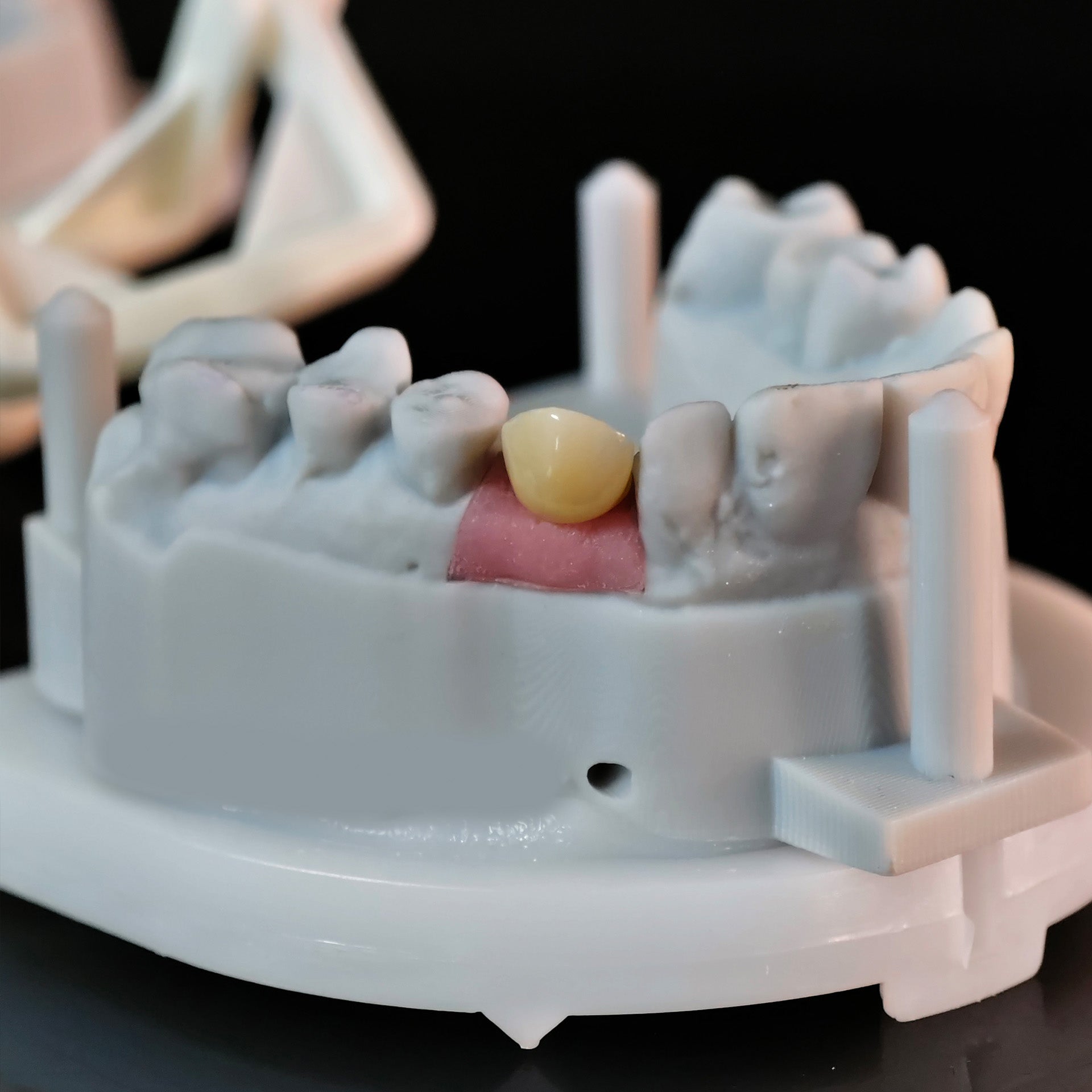 Zirconia Crown With Screw Retained