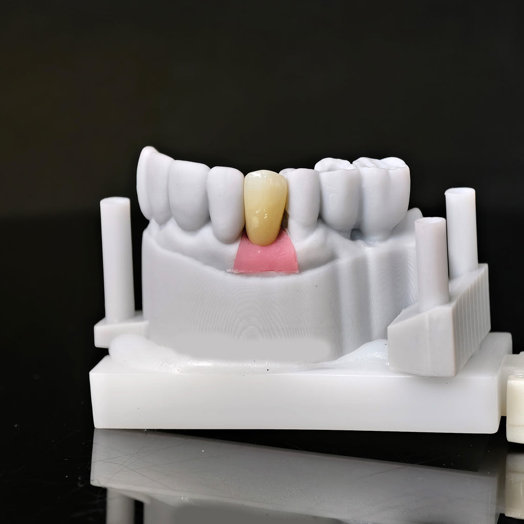 Zirconia Crown With Screw Retained