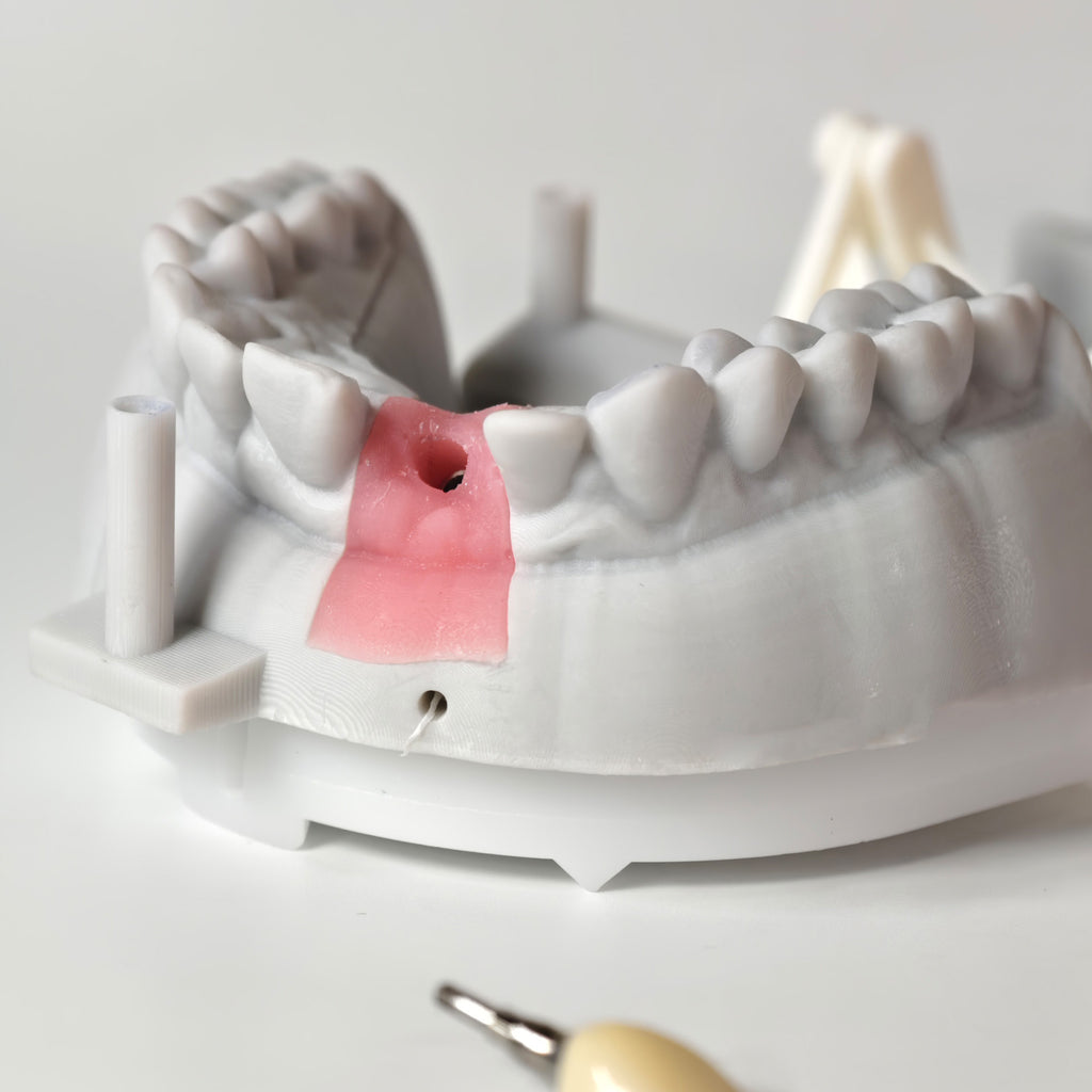 Zirconia Crown With Screw Retained
