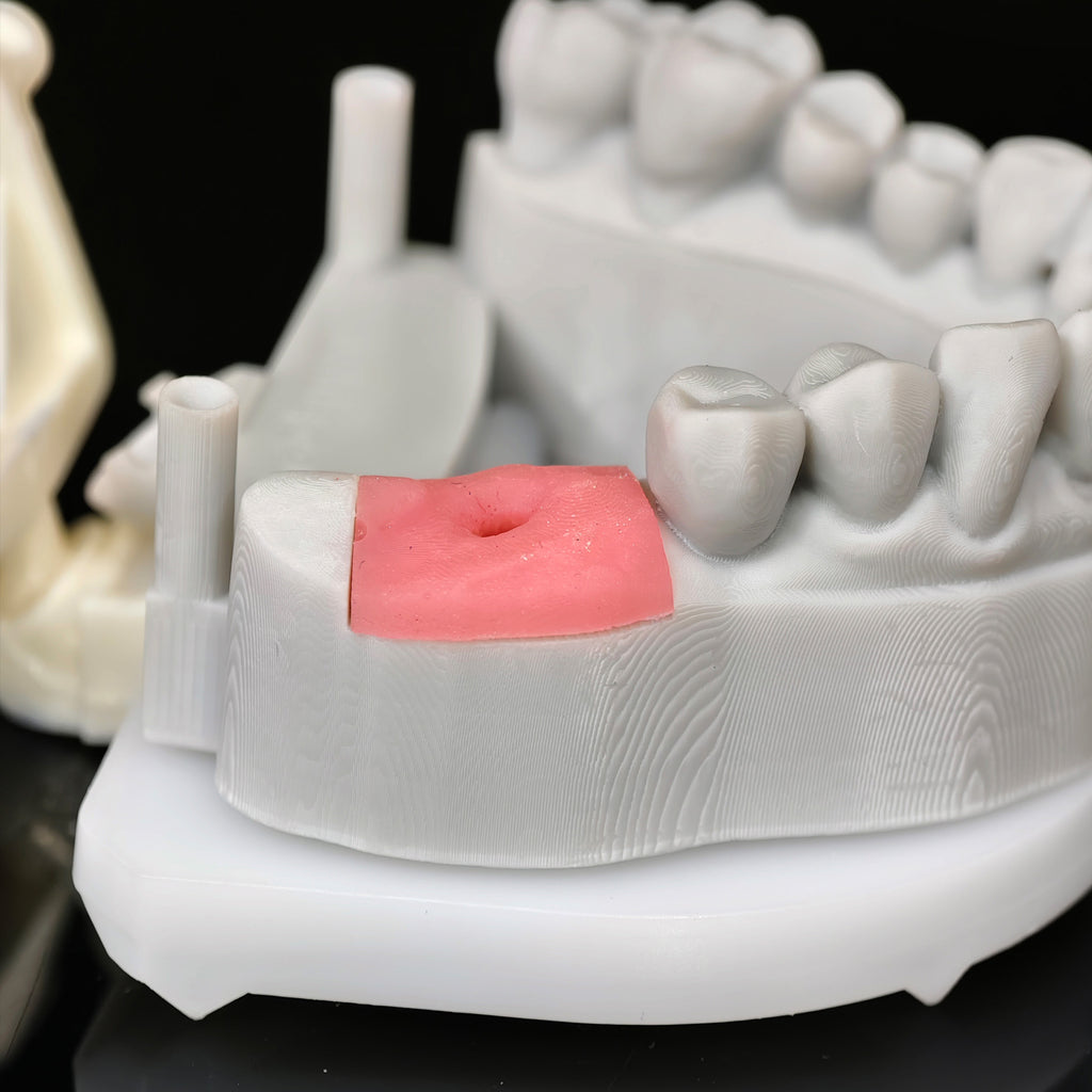 Zirconia Crown With Screw Retained