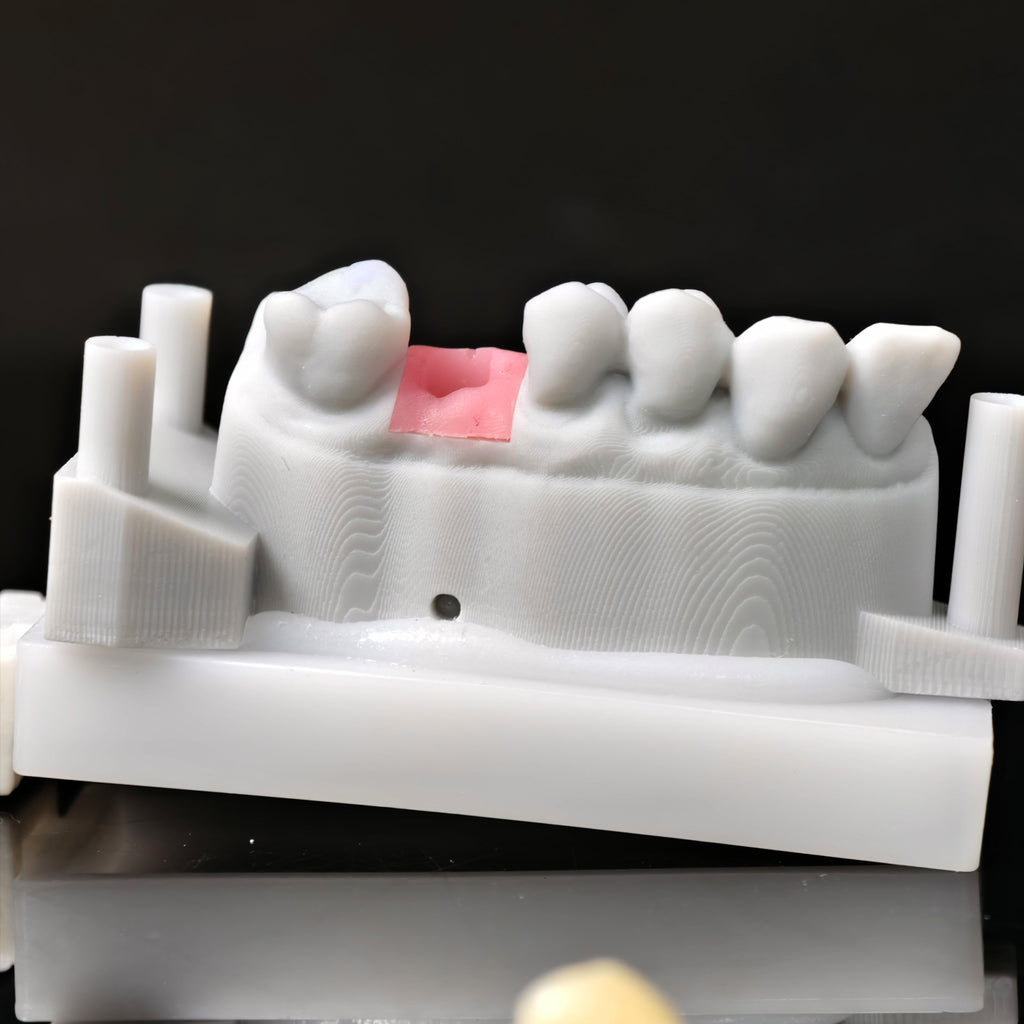 Zirconia Crown With Screw Retained