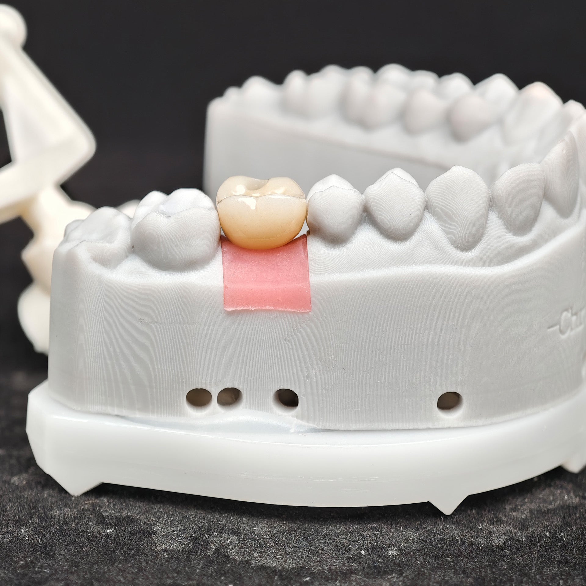 Zirconia Crown With Screw Retained