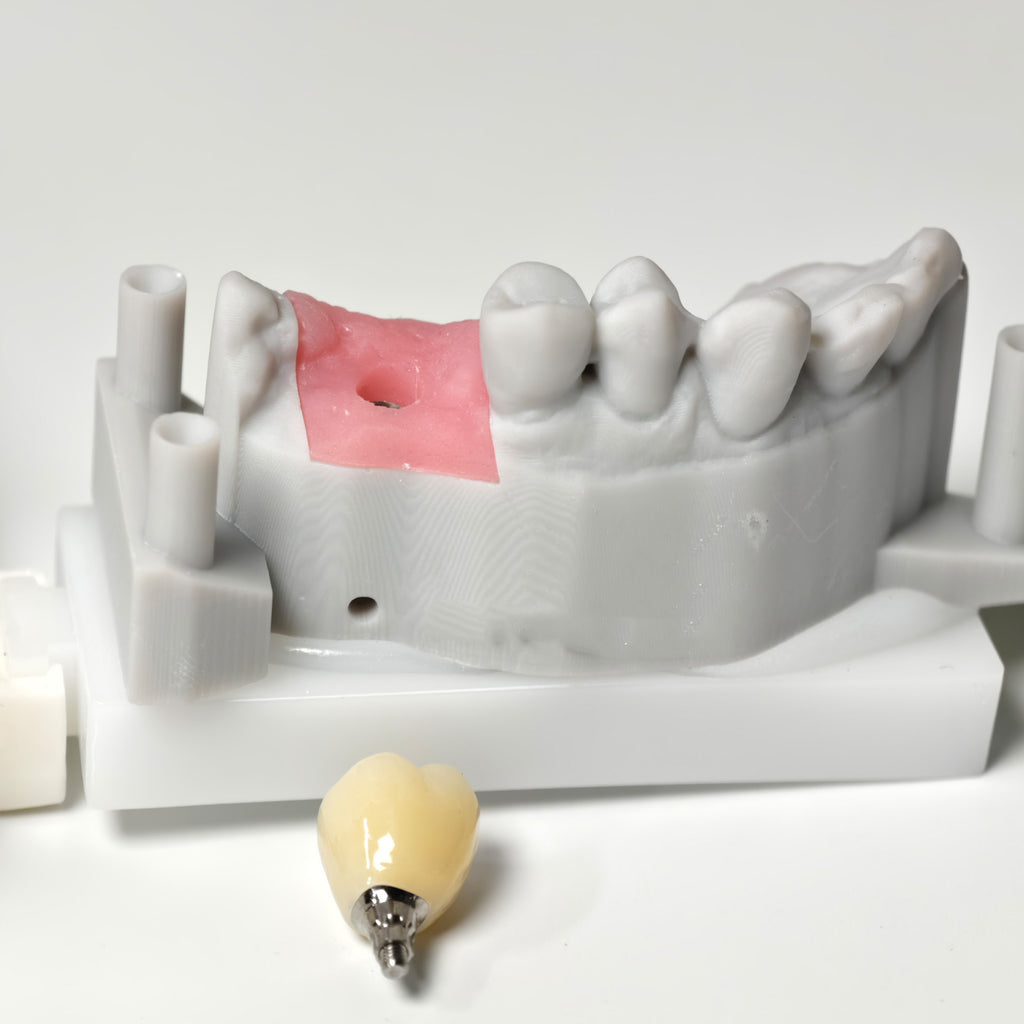 Zirconia Crown With Screw Retained