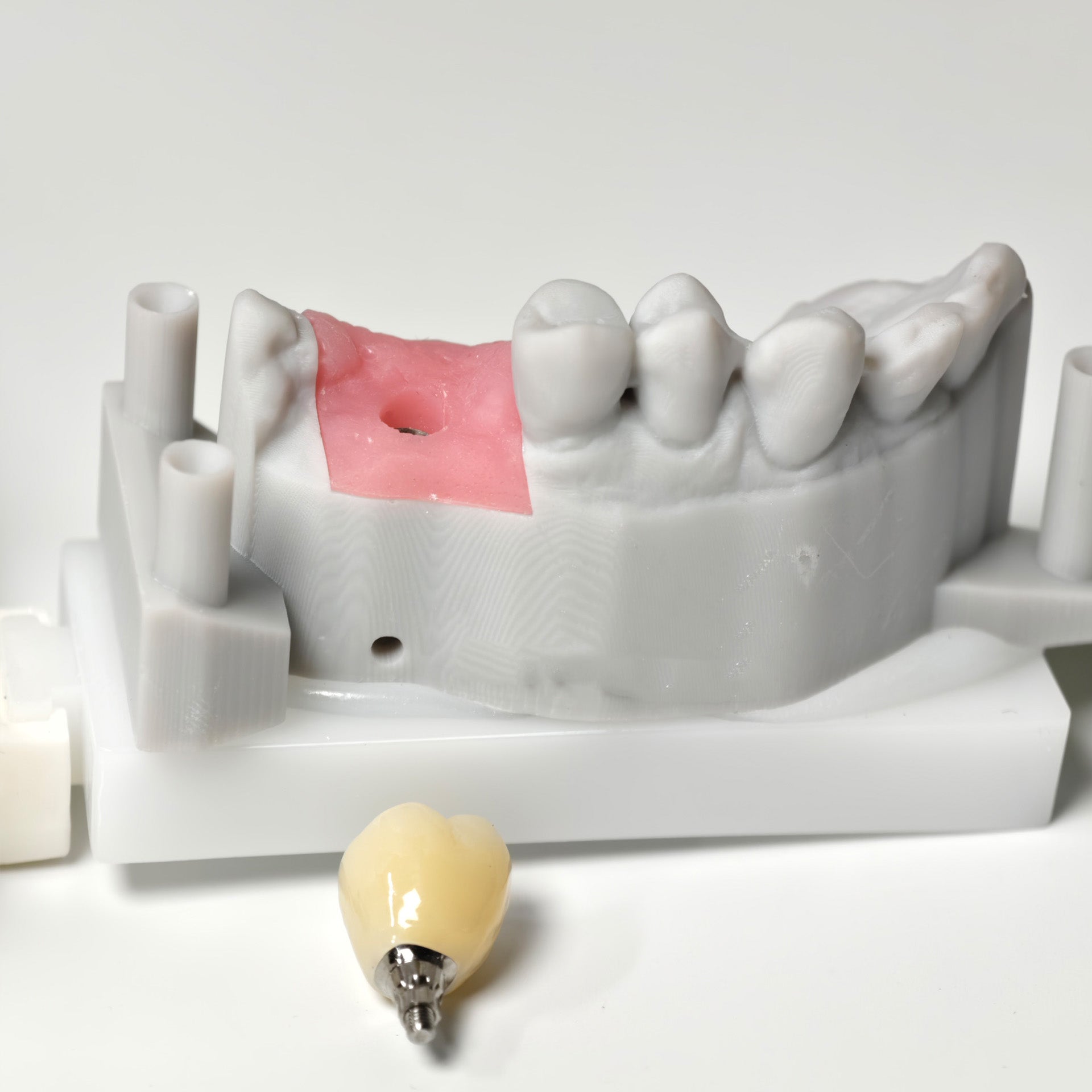 Zirconia Crown With Screw Retained