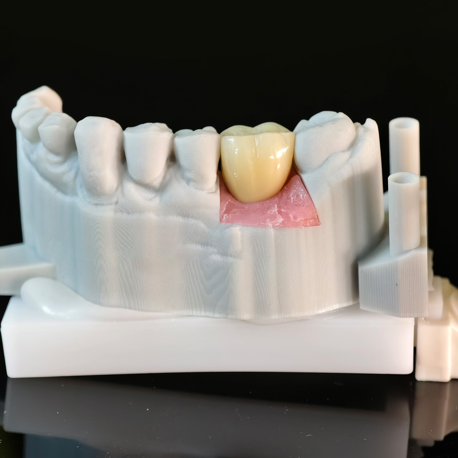 Zirconia Crown With Screw Retained