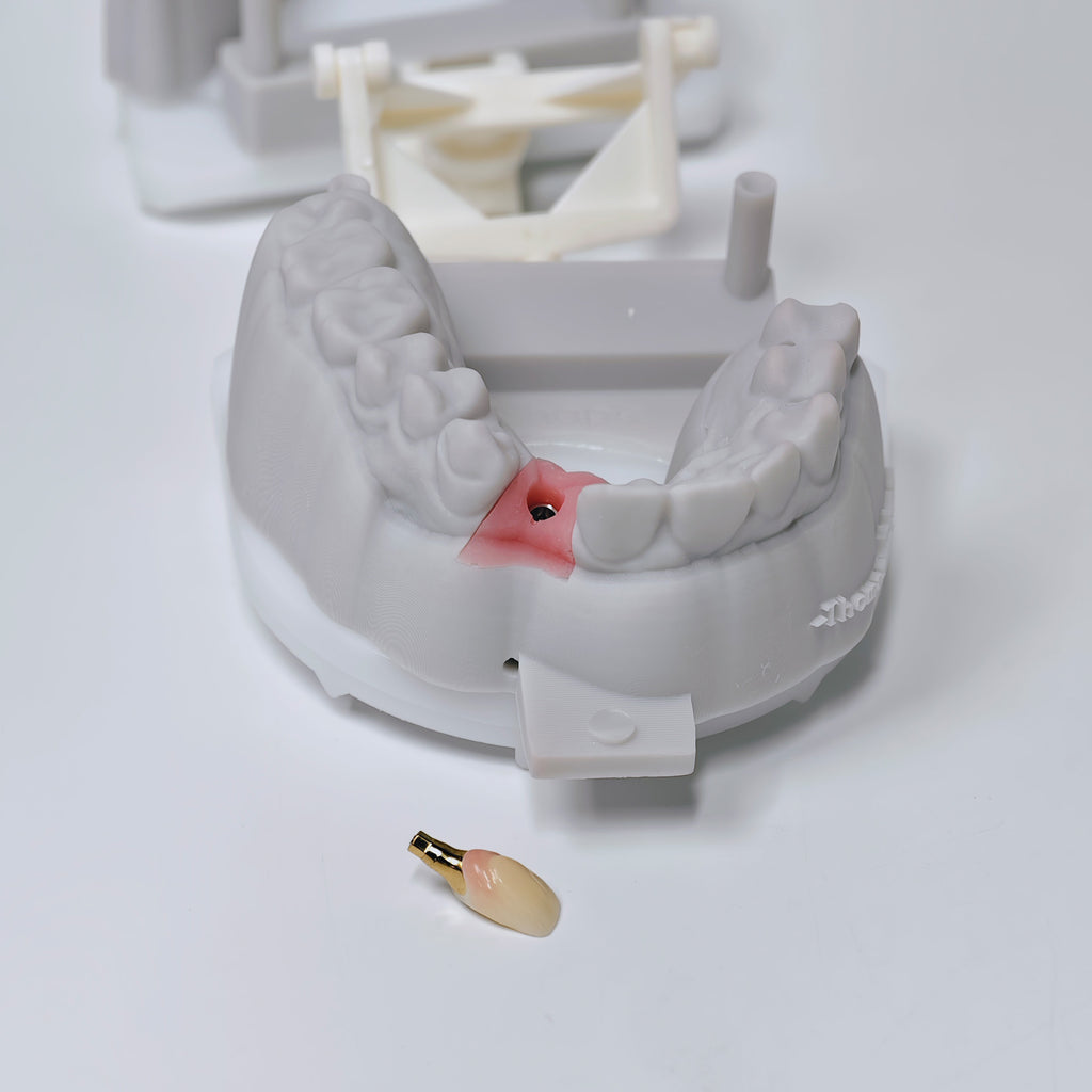 Zirconia Crown With Screw Retained