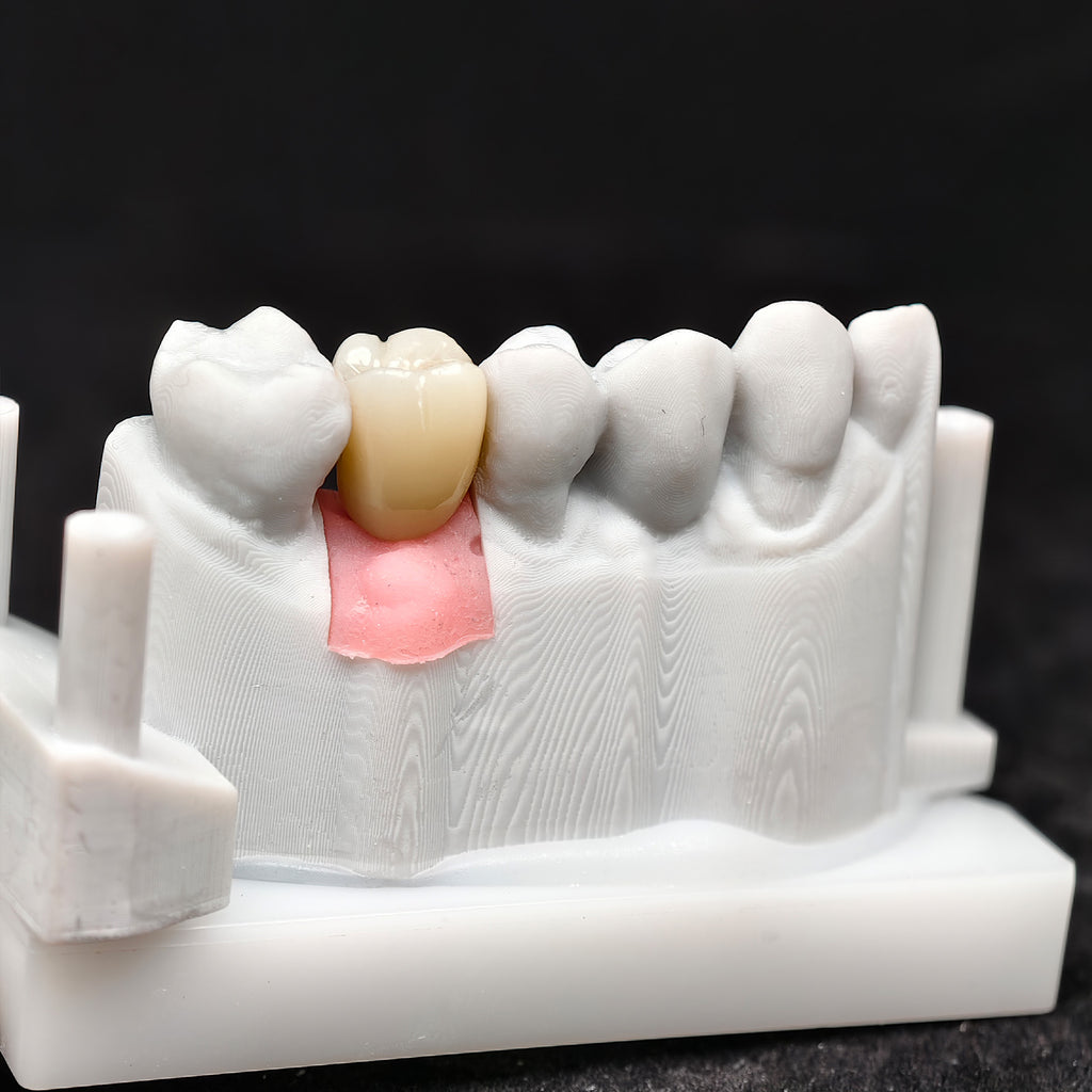 Zirconia Crown With Screw Retained