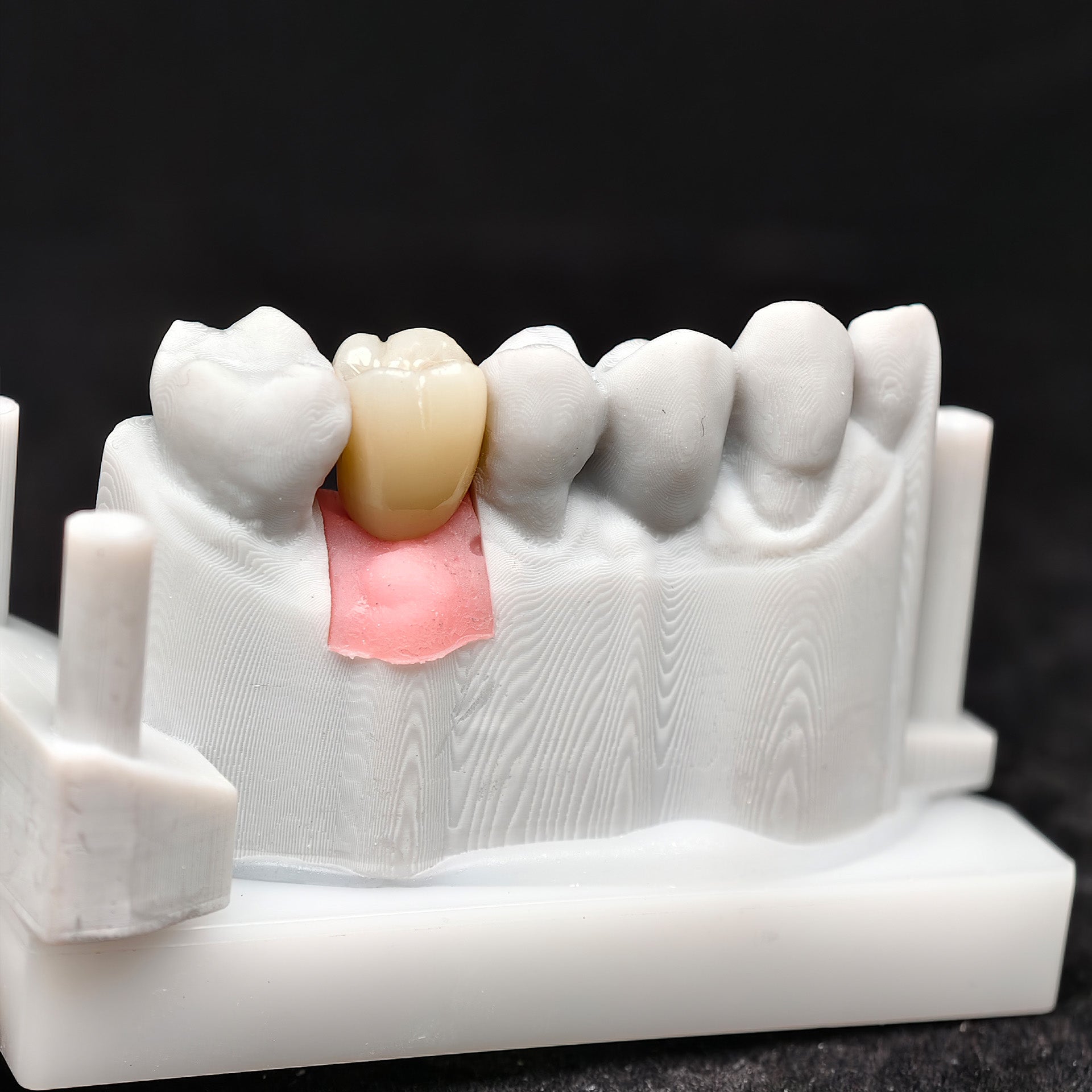 Zirconia Crown With Screw Retained