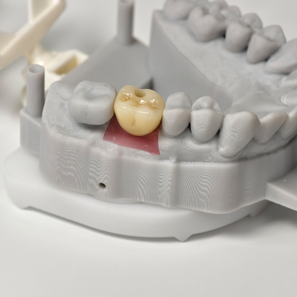 Zirconia Crown With Screw Retained