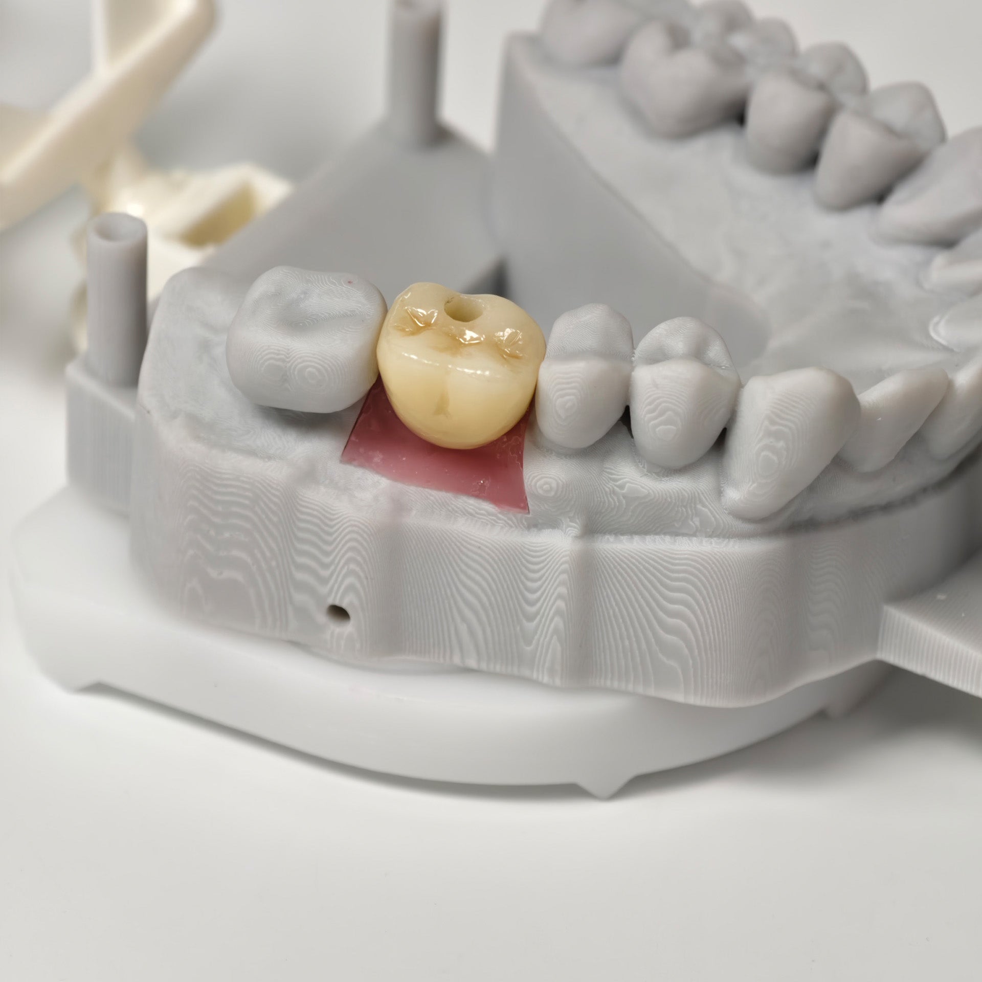 Zirconia Crown With Screw Retained