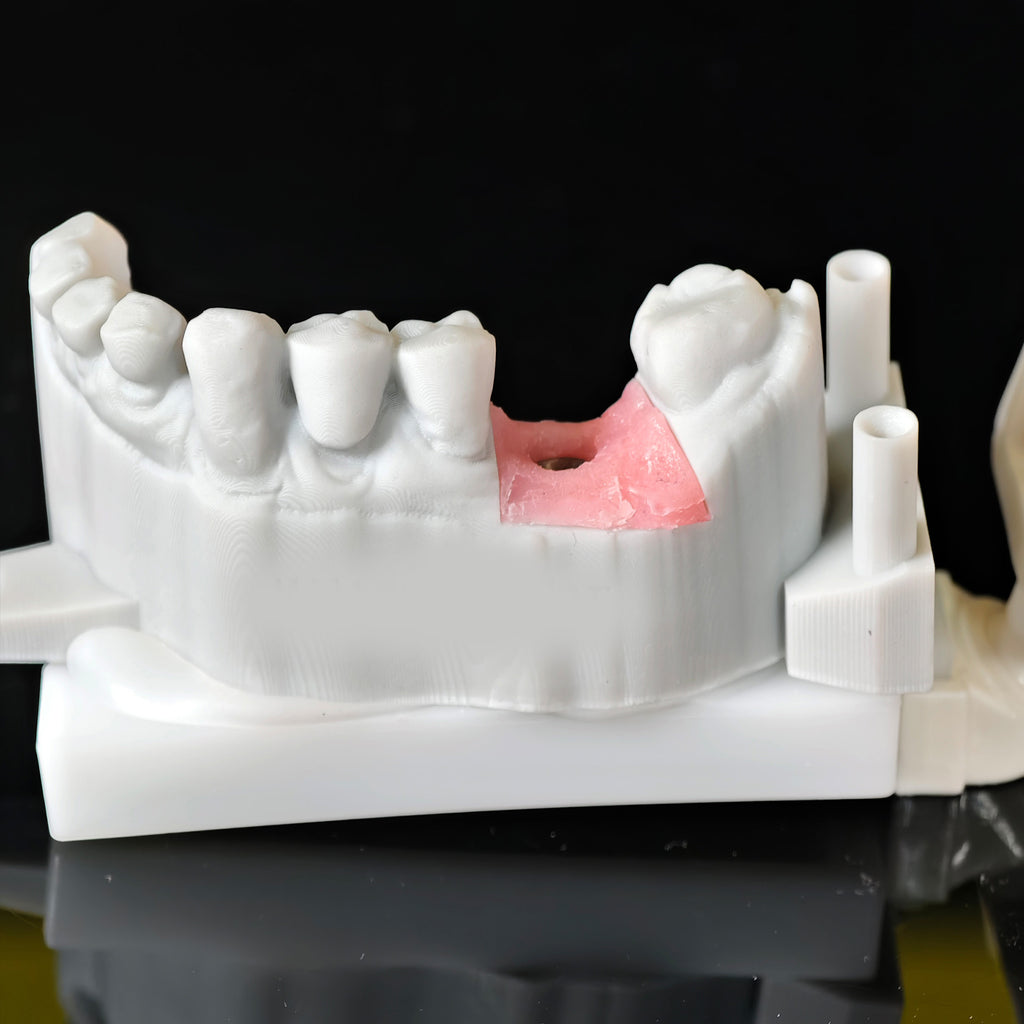 Zirconia Crown With Screw Retained
