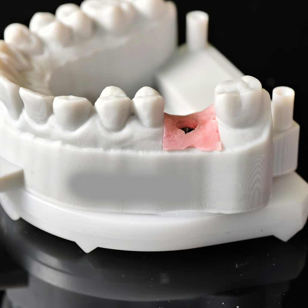 Zirconia Crown With Screw Retained