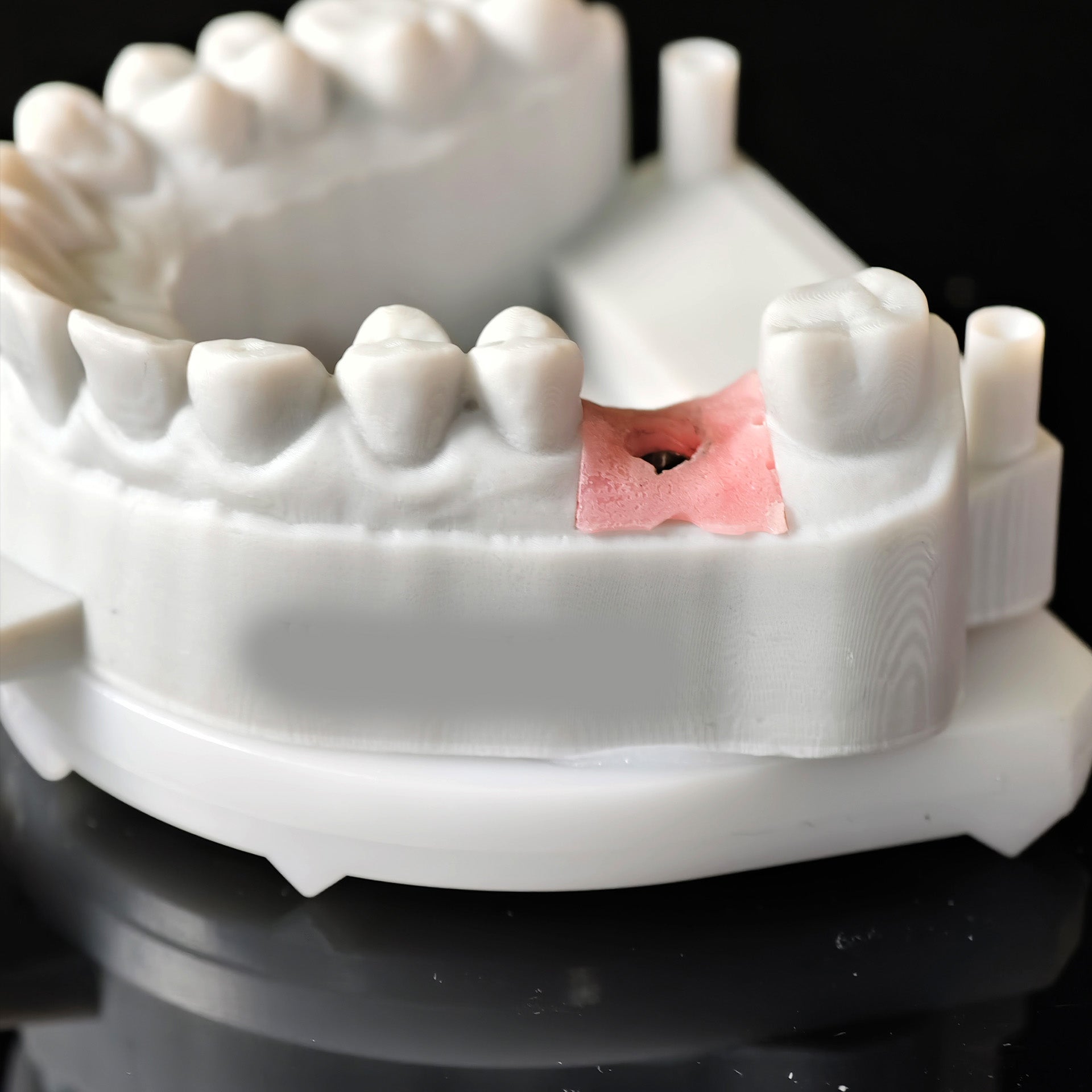 Zirconia Crown With Screw Retained