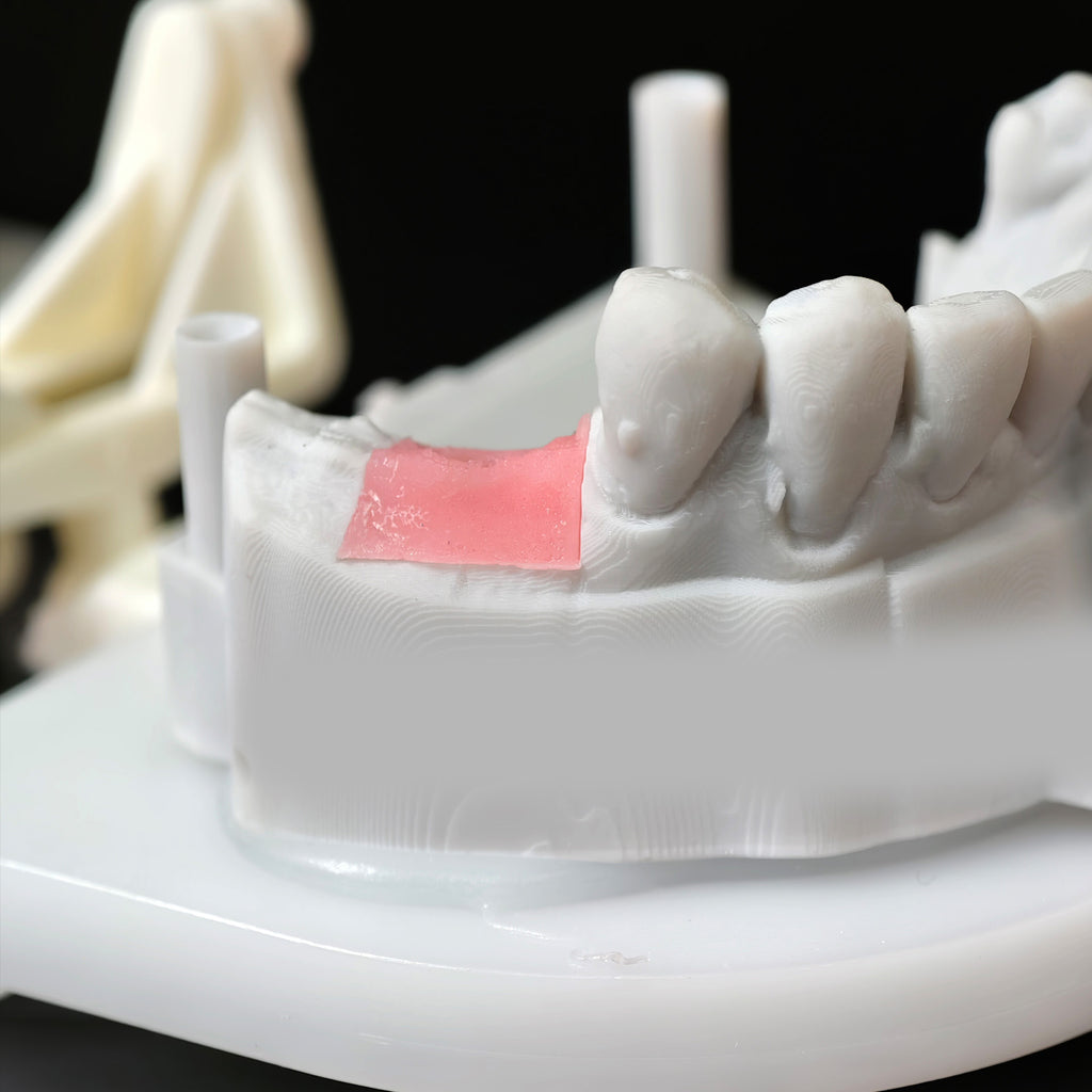 Zirconia Crown With Screw Retained