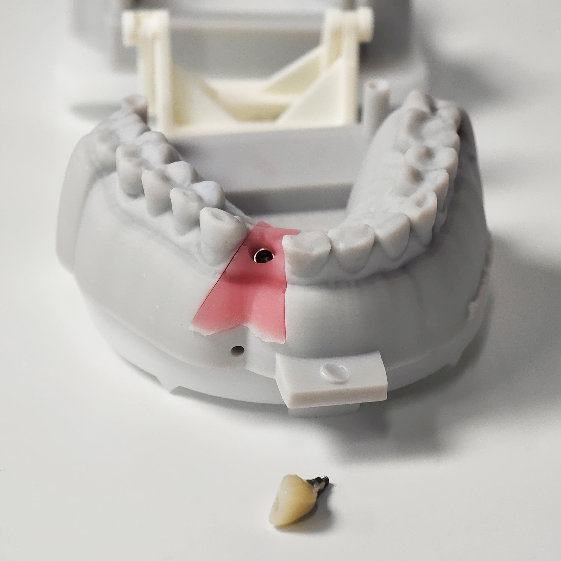 Zirconia Crown With Screw Retained