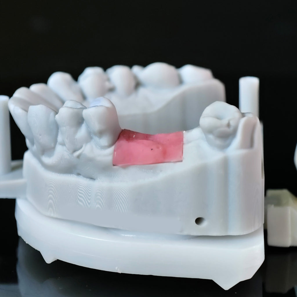 Zirconia Crown With Screw Retained