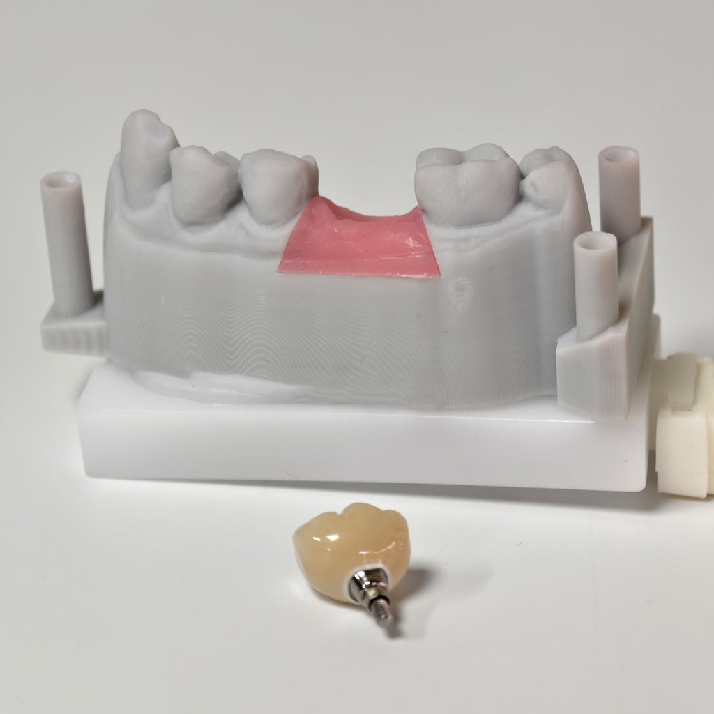 Zirconia Crown With Screw Retained