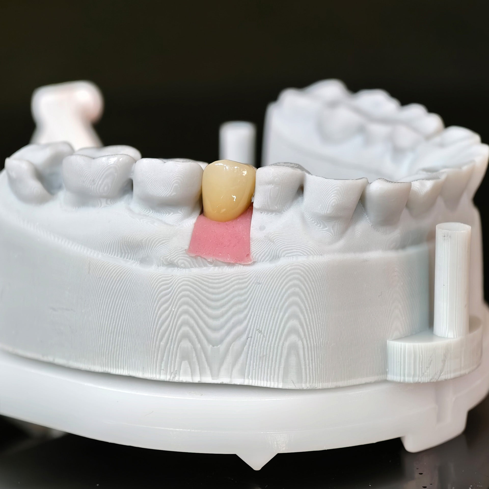 Zirconia Crown With Screw Retained