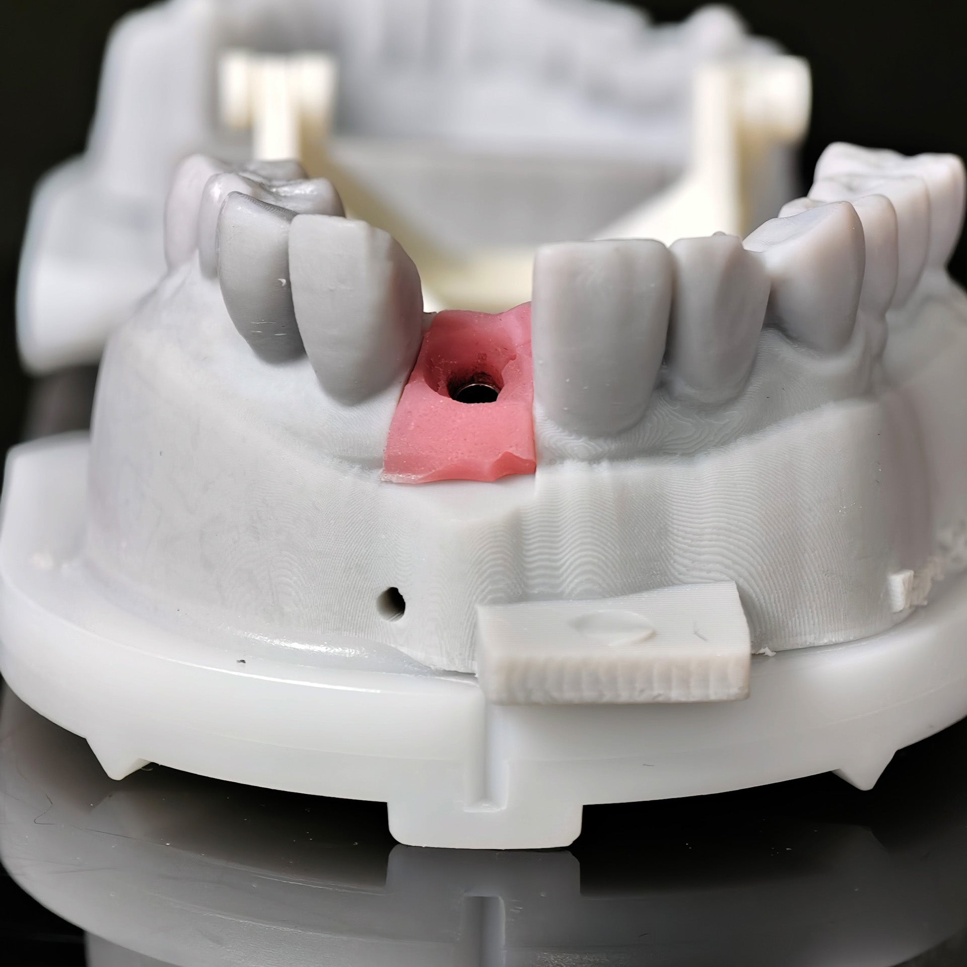 Zirconia Crown With Screw Retained