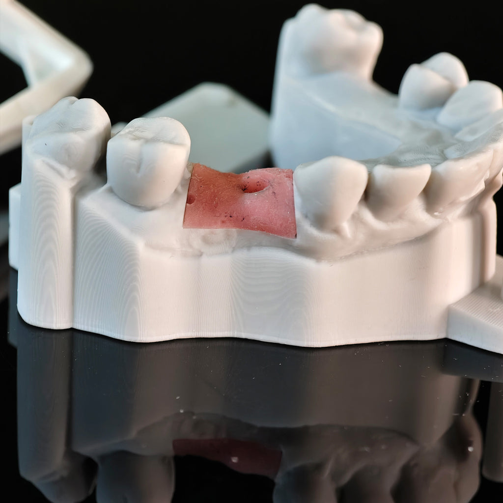 Zirconia Crown With Screw Retained